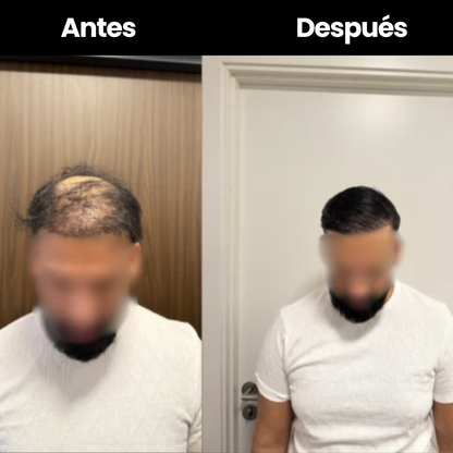 SCULPIX™ | EL MEJOR RELLENO CAPILAR DE CHILE